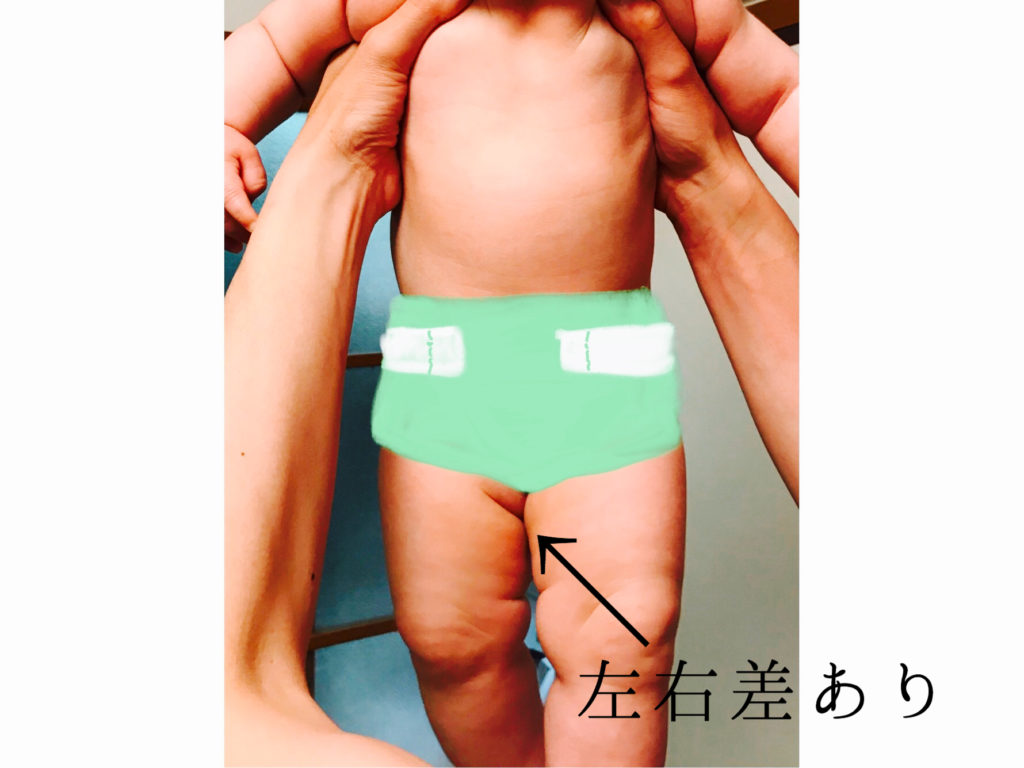 baby- Hip-joint